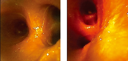 USHIO Theia-40 系列内窥镜实际效果 USHIO Theia-40 系列内窥镜实际效果